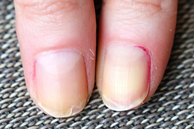 Itchy Cuticles – Why It Happens And What To Do
