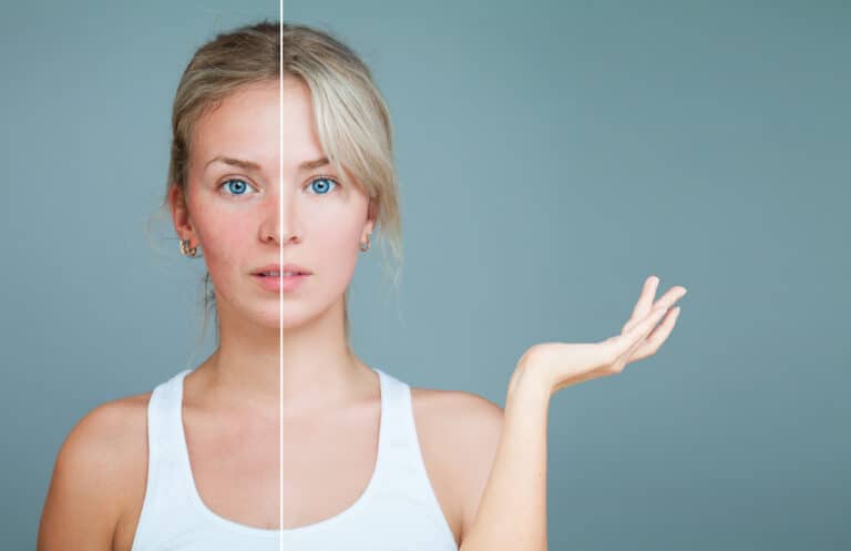 Best The Ordinary Products For Rosacea
