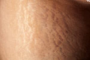 Stretch-Marks-1 - Beautygab Stretch Marks