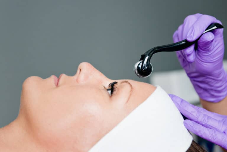 Microneedling