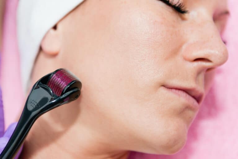 Is Microneedling Permanent?