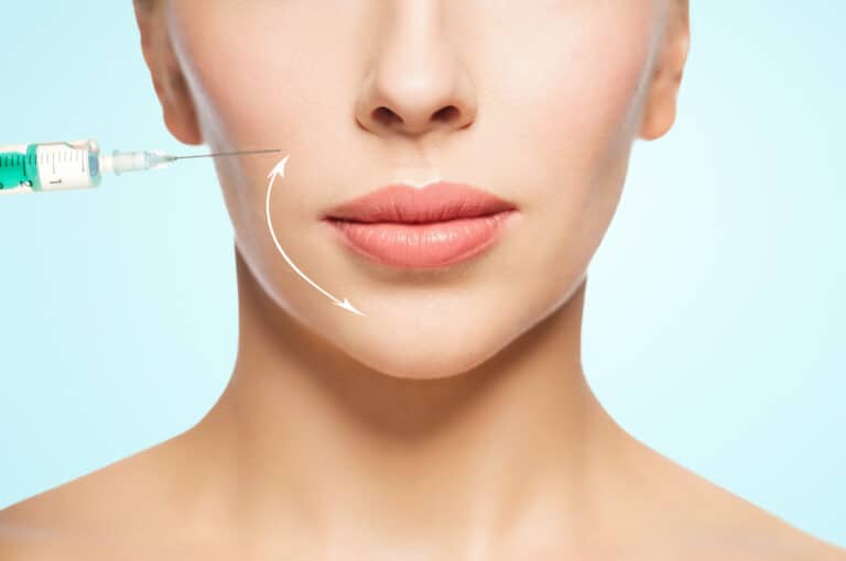 Does Filler Migrate