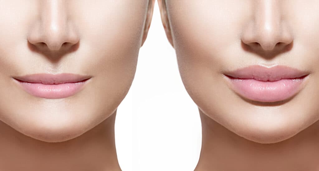 Before and after lip filler injections. Lips closeup over white - Beautygab